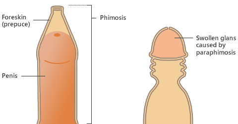 Phimosis : Causes and factors that lead to tight foreskin